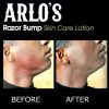 Arlo's Razor Bump Skin Care Lotion 6 oz.